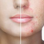 How-to-Get-Rid-of-Acne-Scars_-10-Products-and-Remedies-to-Try.jpg